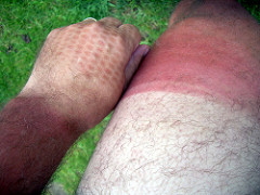 Photo of sunburn by Kordite, via Flickr